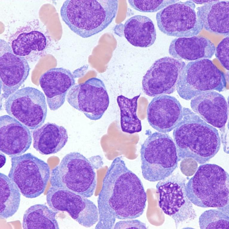Acute myeloid leukemia