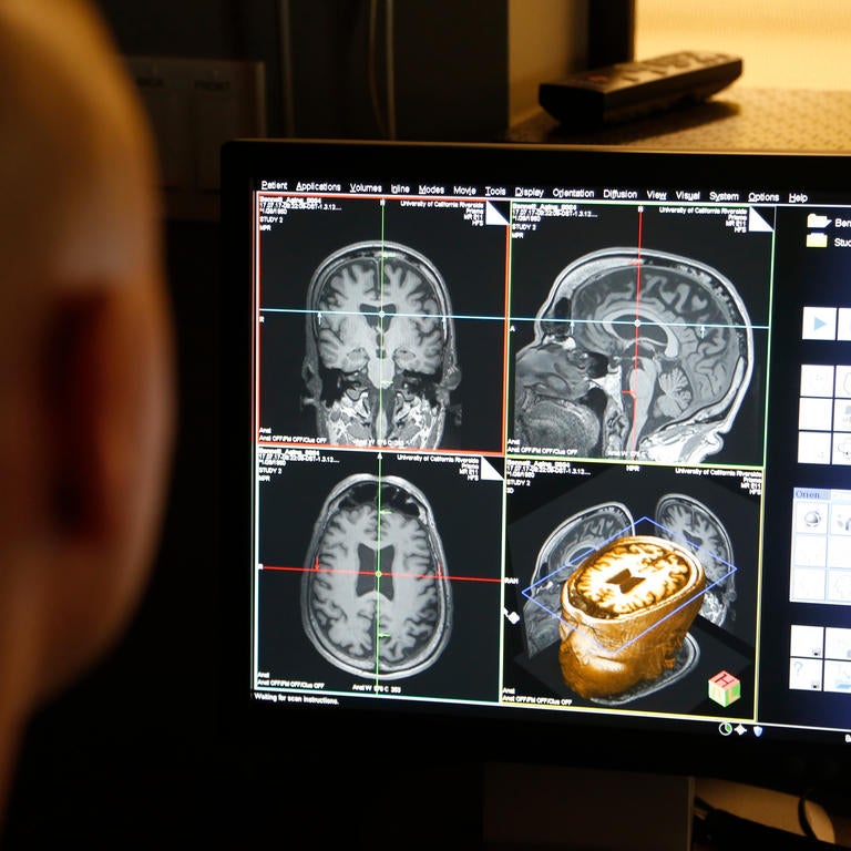 brain scan on computer screen