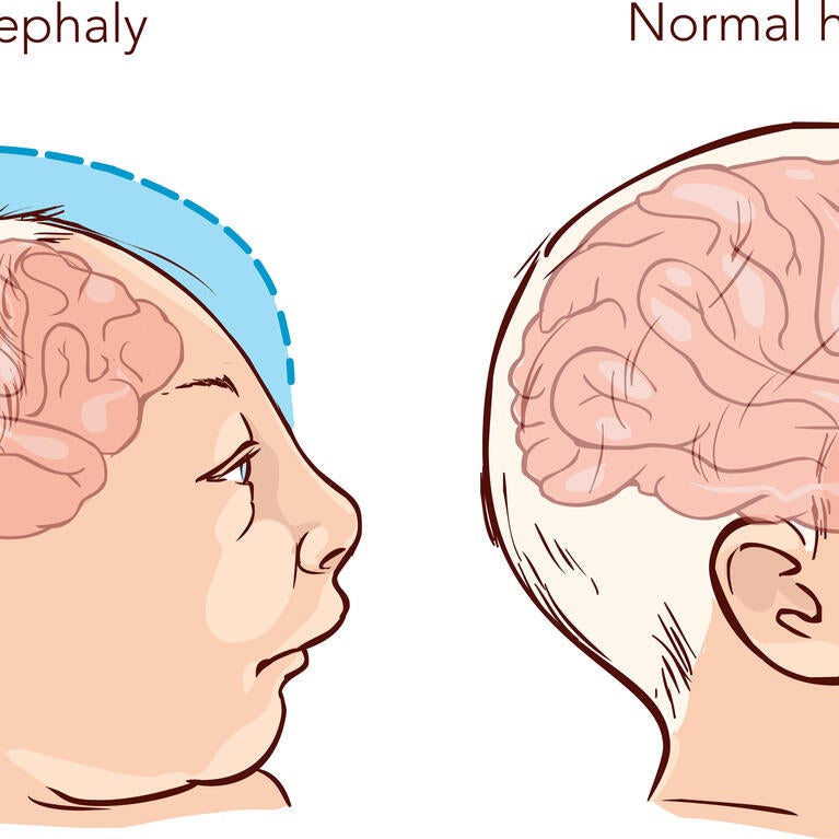 microcephaly
