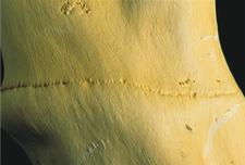 Graft-Transmissible ABSwOr 