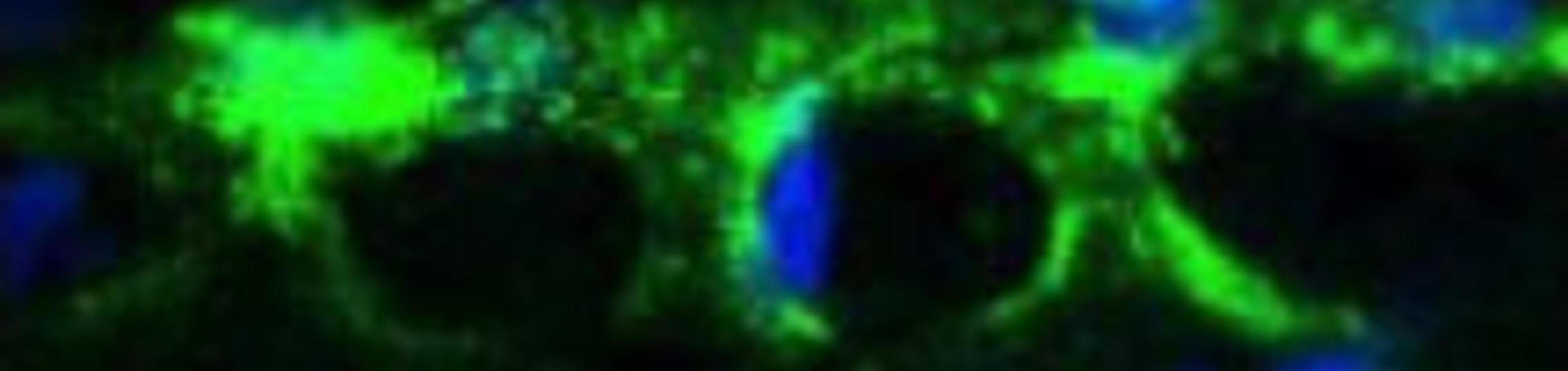 macular degeneration