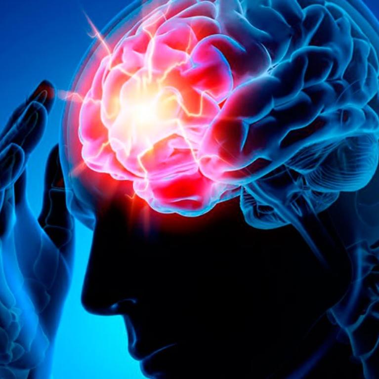 ischemic stroke by Idrewfedd wikimedia commons