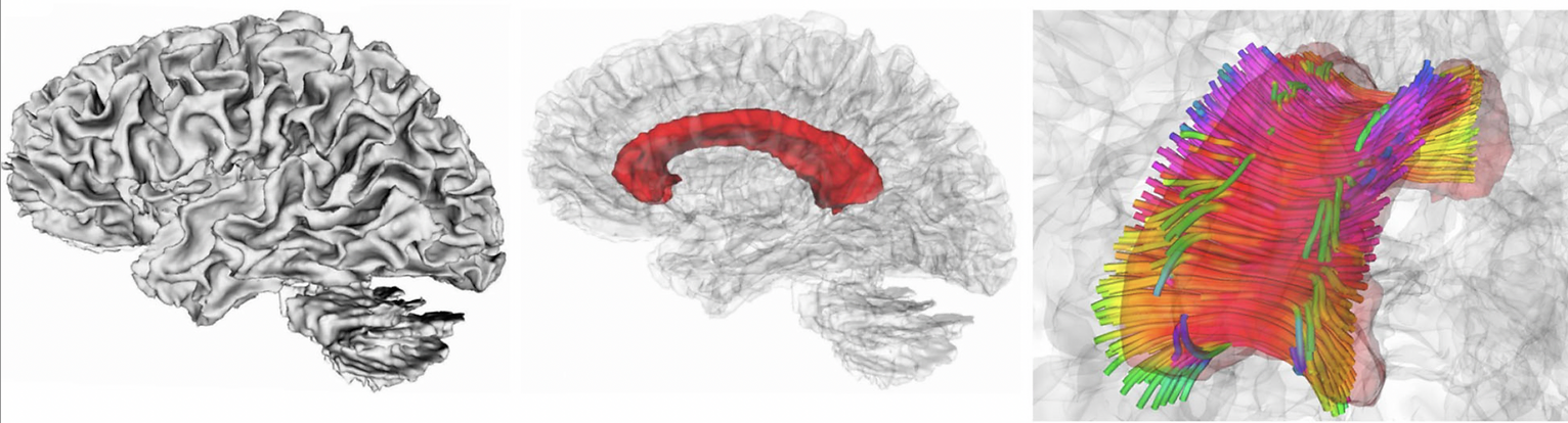 Research image shows views of brain tissue and corpus callosum.