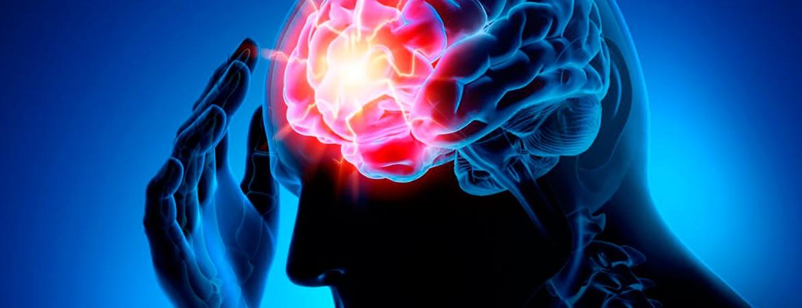 ischemic stroke by Idrewfedd wikimedia commons