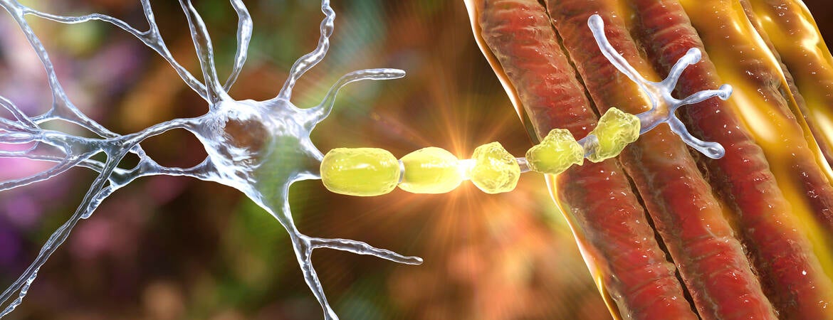 Demyelination of neuron