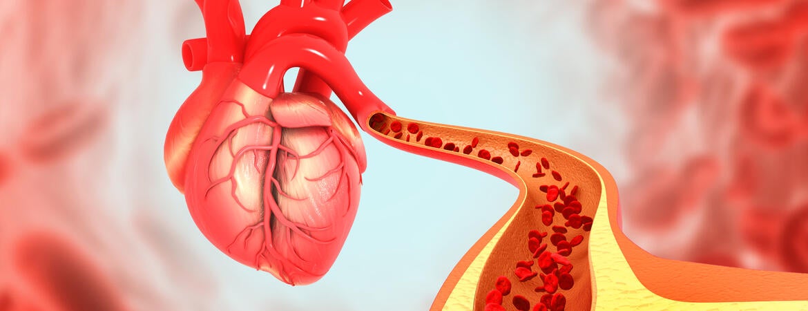 Cholesterol blocked artery