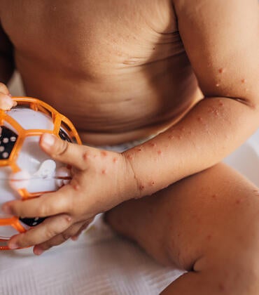 Child with Hand Foot Mouth Disease