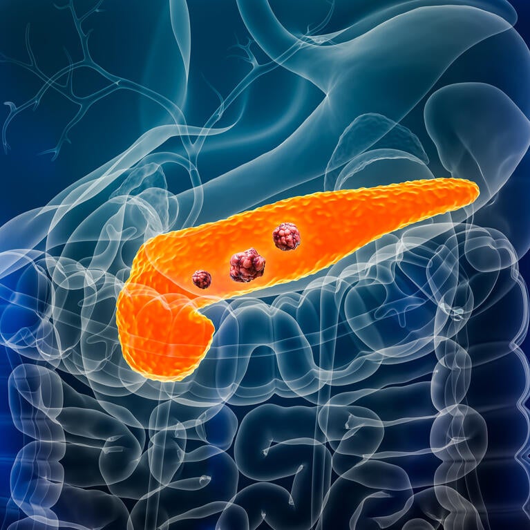 Pancreas or pancreatic cancer with organs and tumors or cancerous cells 3D rendering illustration with male body.