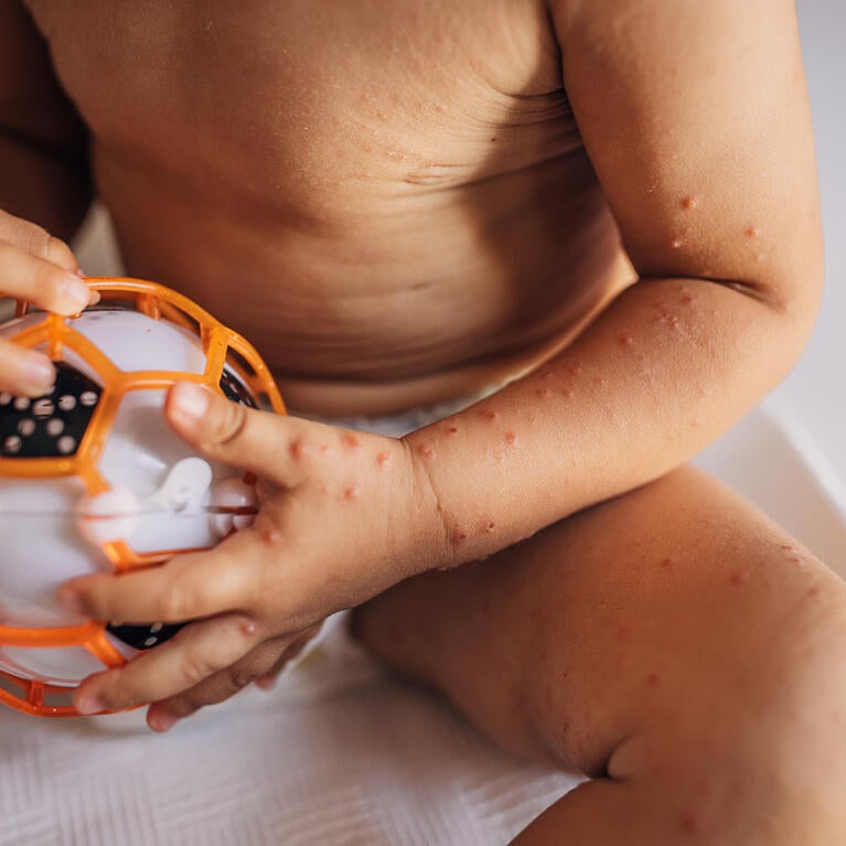 Child with Hand Foot Mouth Disease